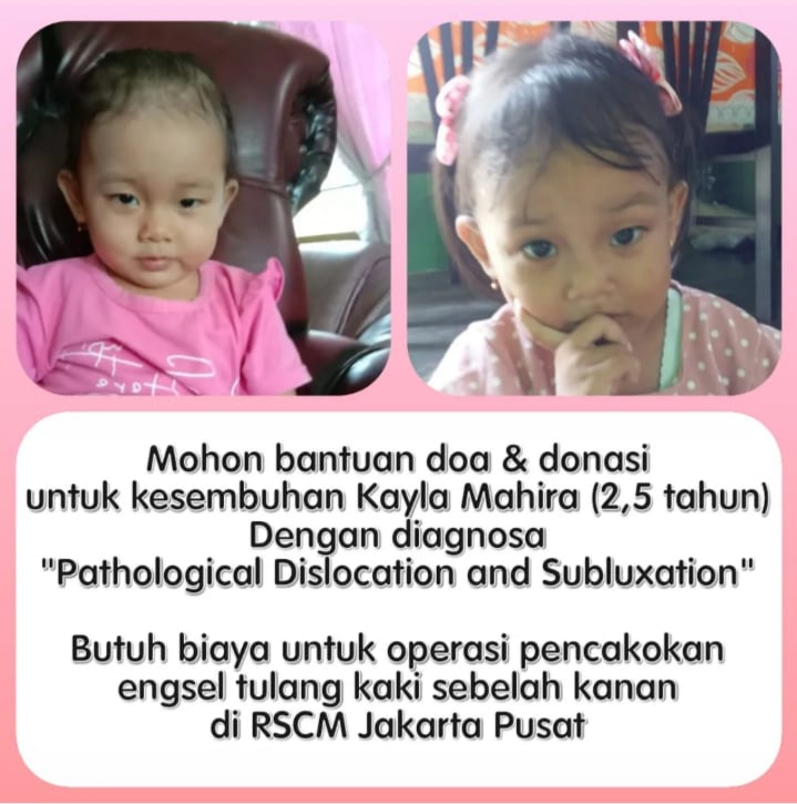 Menderita Pathological Dislocation, Kayla Mahira Butuh Uluran Tangan