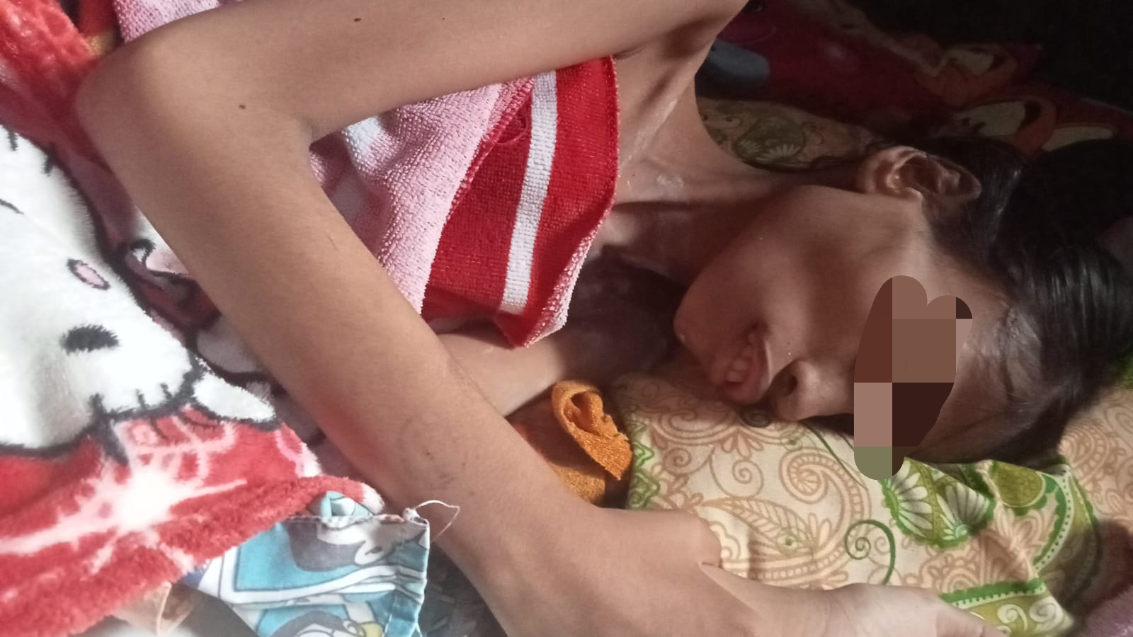 Sempat Berobat Alternatif, Bocah di Desa Kurau Meninggal Akibat Gizi Buruk