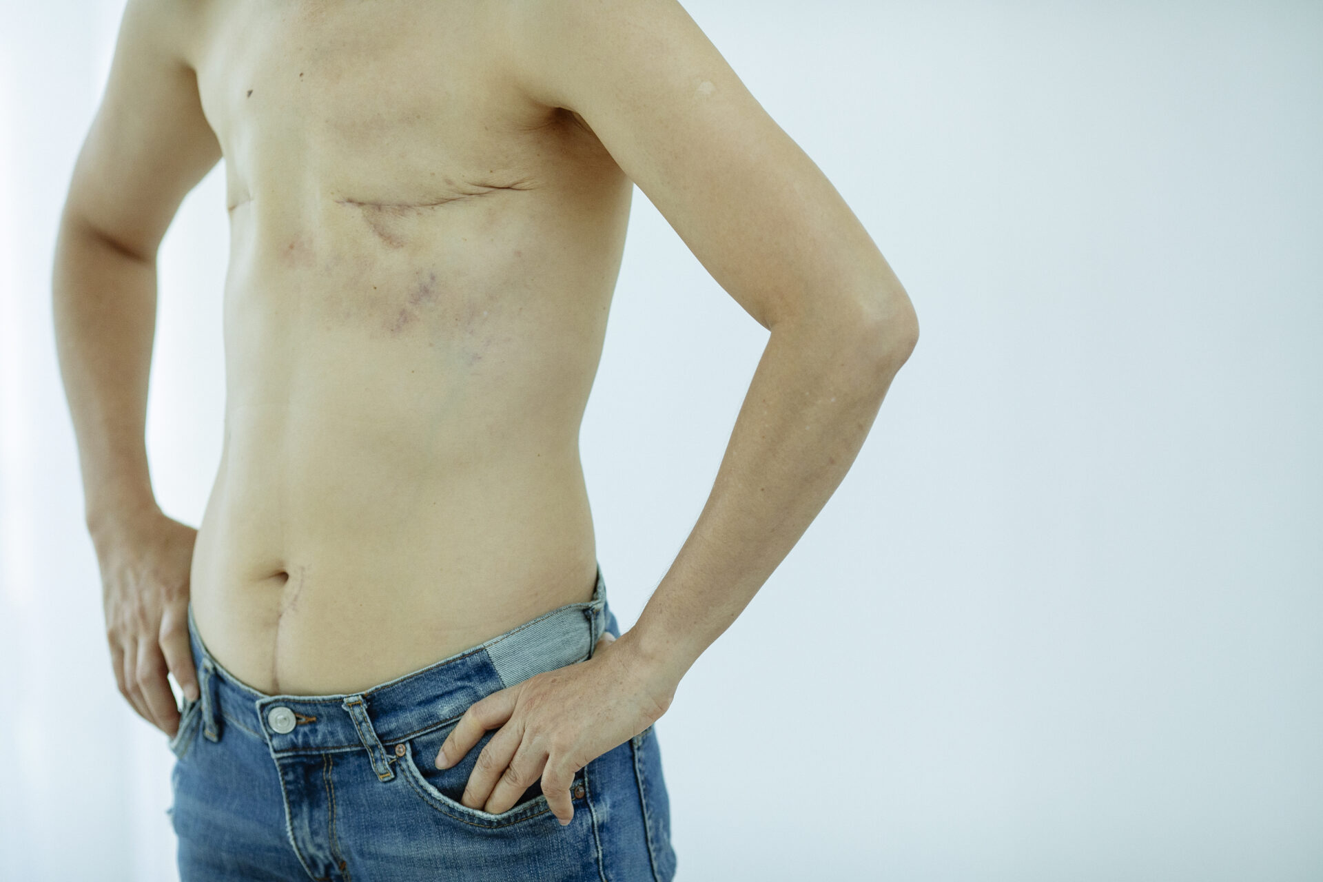 Kesalahan yang Sering Terjadi Saat Merawat Luka Bekas Operasi