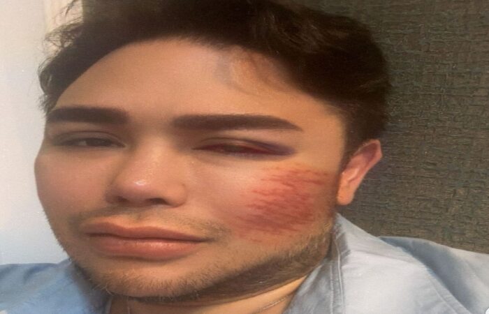 Desainer Ivan Gunawan Unggah Foto Wajah Dirinya yang Luka Lebam, Ada Apa?